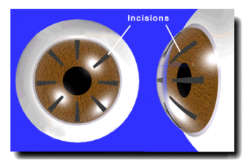 Post-RK cornea