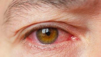 Dry eye syndrome